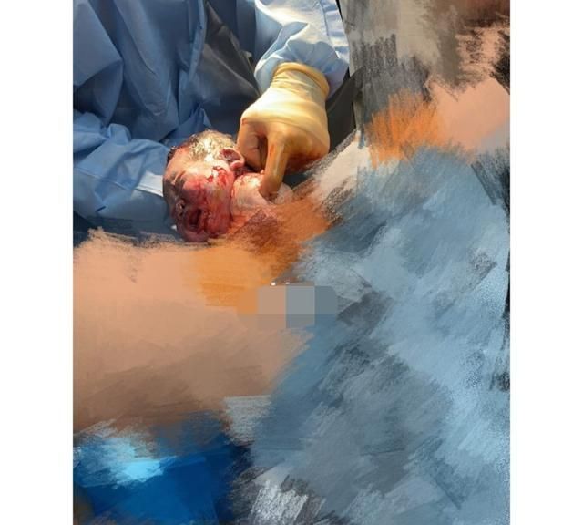 剖腹产3次一般多少周可以剖,剖腹产一般选在多少周图2