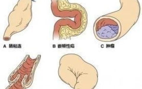 肠梗阻处理原则有哪些
