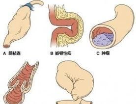 肠梗阻处理原则有哪些图1