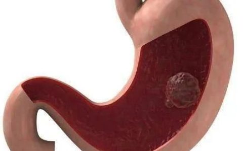 乌梅加白僵蚕能治肠息肉吗,白僵蚕乌梅肉治鼻息肉