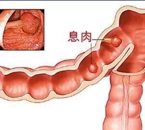乌梅、白僵蚕、威灵仙和炒薏苡仁，简单四味药，治疗息肉有奇效