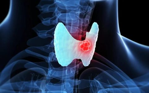 碘131治疗介绍，甲状腺癌碘131治疗是什么？